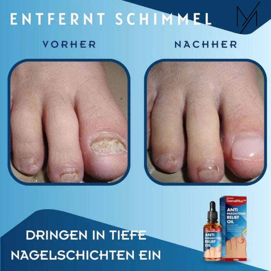 ToeRelief™⎪Ihre Lösung für gesunde Zehen